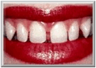 Description: Before Tooth Bondong Procedure