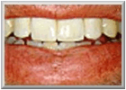 Description: After Dental Cap Procedure