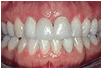 teeth whitening in arroyo grande