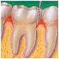 Description: Gingivitis