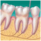 Description: Periodontis