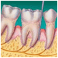 Description: AdvancedPeriodontis