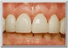 Description: After Tooth Veneer Procedure