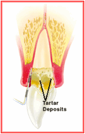 Description: Advanced Periodontitis