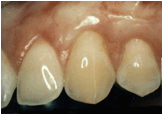 Description: After soft tissue graft